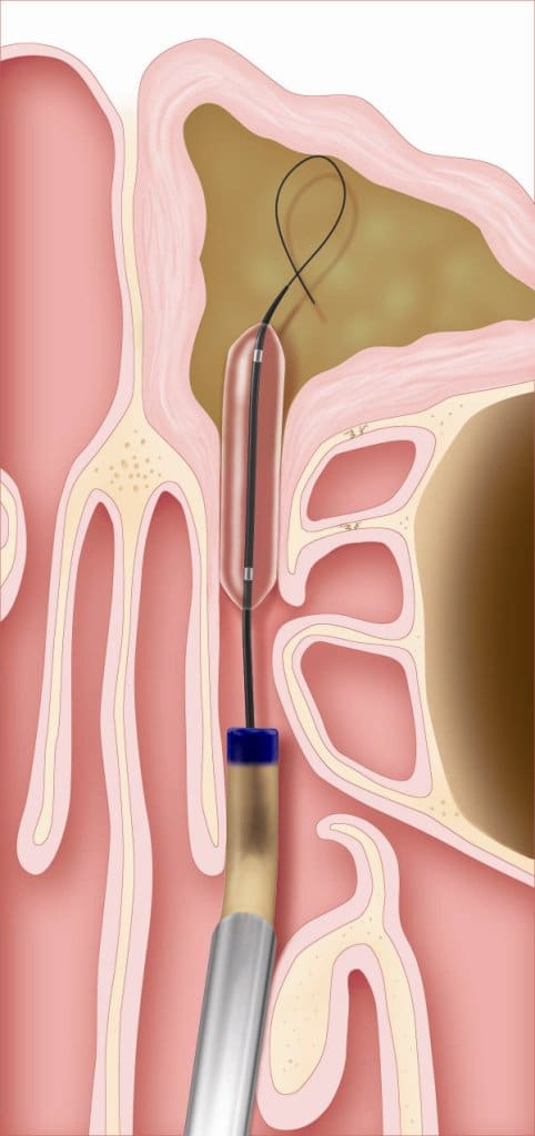 balloon sinuplasty diagram 2